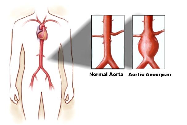 India Surgery Aortic Aneurysm Repair,Cost Aortic Aneurysm Repair, Aortic Aneurysm Repair Surgery