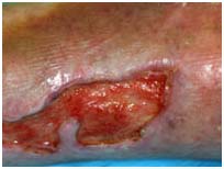 Surgery India Leg Ulcers Treatment, India Cost Lower Leg Ulceration, India Wound Management