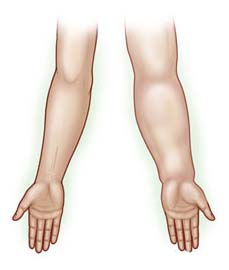 Surgery India Lymphedema, Lymphedema, India Cost Lymphedema Treatment, Lymphedema Treatment