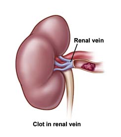 Cost Renovascular Conditions, Radiological Diagnosis And Treatment, India Kidney, India Artery Stenosis