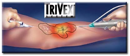 Surgery India Trivex Advanced Varicose Veins, Cost Trivex Varicose, Trivex-Advanced Varicose Vein Treatment