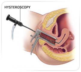 Hysteroscopy, Hysteroscopy India, Procedure of Hysteroscopy, complications of Hysteroscopy, Surgical Procedure
