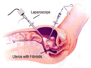 Myomectomy, Myomectomy India, Myomectomy Surgery India, , uterine myomectomy,  uterine fibroid