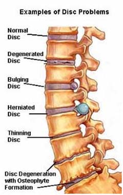 Spinal Disorders India, Spine Conditions India, Lamintomy Surgery India