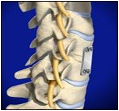 Anterior Cervical Discectomy India, ACD,  Neck Pain, Spine Surgery Anatomy, Herniation, Herniated Disc