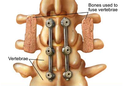 Vertebrae India, Bone Graft India, Spine Fusion India, Spine Fusion Surgery Vertebrae India