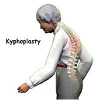Kyphosis, Curves, Anterior, Posterior, Surgery For Kyphosis, Kyphosis Picture, Kyphosis Cause, Kyphosis Symptom, Kyphosis Diagnosis