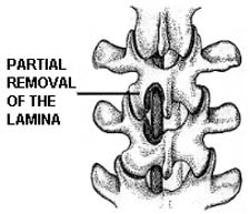 , Herniated Disc, Low Cost Lumbar Laminectomy Surgery India, Bone Spurs India, Side Effects India