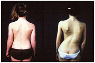 Scoliosis Surgery India, Scoliosis Surgery, Back Braces, Observation, TLSO, Charleston Bending