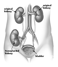 Pancreas Kidney Transplant  India, India Kidney India