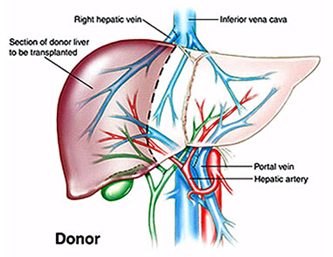 Liver Transplant Surgery India offers info on Liver Transplant Surgeon India, Liver Surgery India