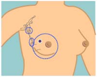 Breast Cancer,Breast Cancer Surgery India, India Surgery Breast Cancer
