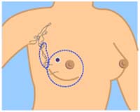 India Surgery Breast Cancer,Breast Cancer,India Surgery Breast Cancer,Cost Breast Cancer,Breast Cancer Stage’s