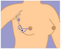 India Surgery Breast Cancer,Breast Cancer,Breast Cancer Surgery India, Cost Breast Cancer,Breast Cancer Stage’s, Breast Cancer
