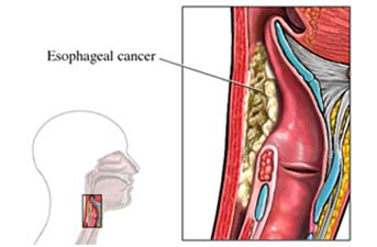 Esophageal Cancer Surgery, India Surgery Cancer Of The Esophagus, India Surgery Esophageal Resections