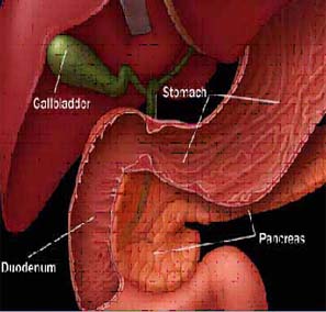 Cost Pancreatic Cancer, Pancreatic Cancer, India Surgery Pancreatic Cancer Treatment, Pancreatic Adenocarcinoma