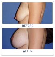 Surgery India Breast Lift Surgery, Brest Lift, Breast Lift Surgery, India Breast Lift