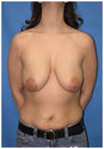 Brest Lift, Breast Lift Surgery, India Breast Lift Surgery, India Breast Lift