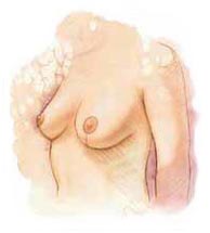 Surgery India Breast Lift Surgery, Cost Breast Lift Surgery, Breast Lift Surgery, India Breast Lift