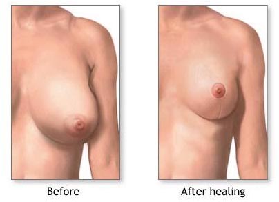 Surgery India Breast Reduction Surgery, India Reduction Mammaplasty, India Breast Reduction Surgery, India Benefits Of Breast Reduction Surgery