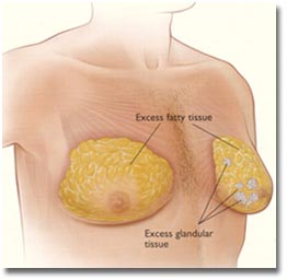 Breast reduction cost in india
