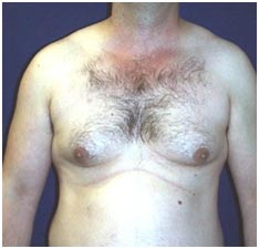 Cost Breast Reduction India, Male Breast Surgery, India Male Breast Reduction, India Male Breast Reduction Surgery