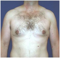 Male Breast Surgery, India Male Breast Reduction, India Common Disorder Of The Male Breast, India Male Chest Reduction