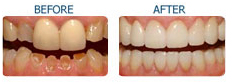 Cosmetic Dentistry India, Cost Cosmetic Dentistry India, India Dental Surgeon India