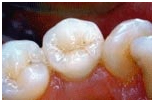 Dental Inlay Treatment, Dental Inlay Treatment, India Porcelain Inlay