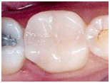 Dental Inlay Treatment, Dental Inlay Treatment, India Porcelain Inlay, Cost Ceramic Dental Inlay