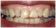 Dental Implants India, Full Mouth Dental, Full Mouth Rehabilitation India, Dental Implants India