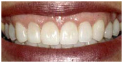 Full Mouth Rehabilitation India, Full Mouth Rehabilitation India,Full Mouth Dental Implants India