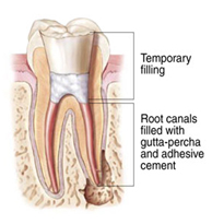 Root Canal Treatment India, Cost Root Canal Treatment Hospital India, Root Canal Treatment Delhi India