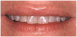 Cost Smile Design India, Smile Designing, Cosmetic Dentistry, Tooth Whitening