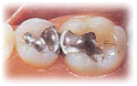 India Surgery Teeth Polishing Fluoride,India Low Cost Teeth Polishing Fluoride