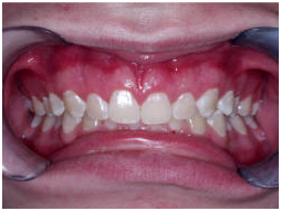 India Surgery Teeth Polishing Fluoride,Cost Teeth Polishing Fluoride, India Low Cost Teeth Polishing Fluoride