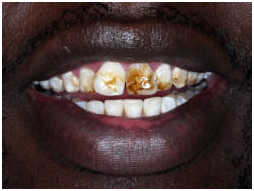 Cost Teeth Polishing Fluoride, Teeth Polishing Fluoride, India Low Cost Teeth Polishing Fluoride