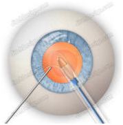 Intraocular Lens Implant Information, Intra Ocular Lens Implants Advice, Intraocular Lens Implant Treatment, India Intraocular Lenses