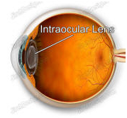 Contact Lens, Eye Operation, India Intraocular Lenses, Intraocular Lenses