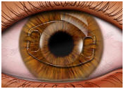 Intraocular Lens Implantation, Intraocular Lenses Implantation, Eye Surgeons, Cataract Surgery