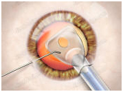 Intraocular Lens Implant Information, Intra Ocular Lens Implants Advice, Intraocular Lens Implant Treatment