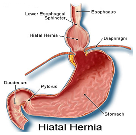 India Surgery Gastric Hiatus Hernia, Gastric Hiatus Hernia Surgery, Gastric, India Hiatus Hernia