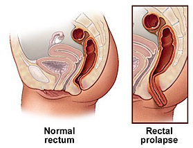 India Surgery Rectal Prolapse Surgery, Cost Rectal Prolapse Treatment, Rectal Prolapse Surgery