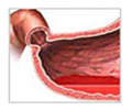 India Surgery Stomach Ulcer, Cost Ulcer Treatment, Ulcers Treatment, India Cost Gastric- Duodenal Ulcer Treatment Hospital