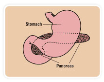 India Cost Pancreatic Surgery, Pancreatic Surgery, India Pancreatic, India Pancreatic Surgery
