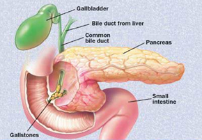 Gallstones,Cost Minimally Invasive Gallstone, Gallstones Surgery, India Gallstones Surgery