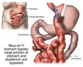 India Surgery Gastric Bypass,Cost Minimally Invasive Gastric Bypass, Gastric Bypass Surgery, Bypass Surgery