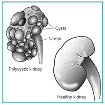 India Surgery Polycystic Kidney Disorder,Polycystic Kidney Disease, Polycystic Kidney Disorder Treatment India