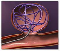 Cost Endovascular Coiling, India Endovascular Coiling Surgery India, India Coiling