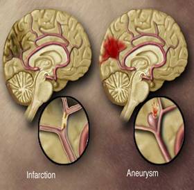 Cerebral Aneurysm Treatment India, India Cerebral Aneurysm, India Brain Aneurysm, India Cerebral Aneurysm Treatment